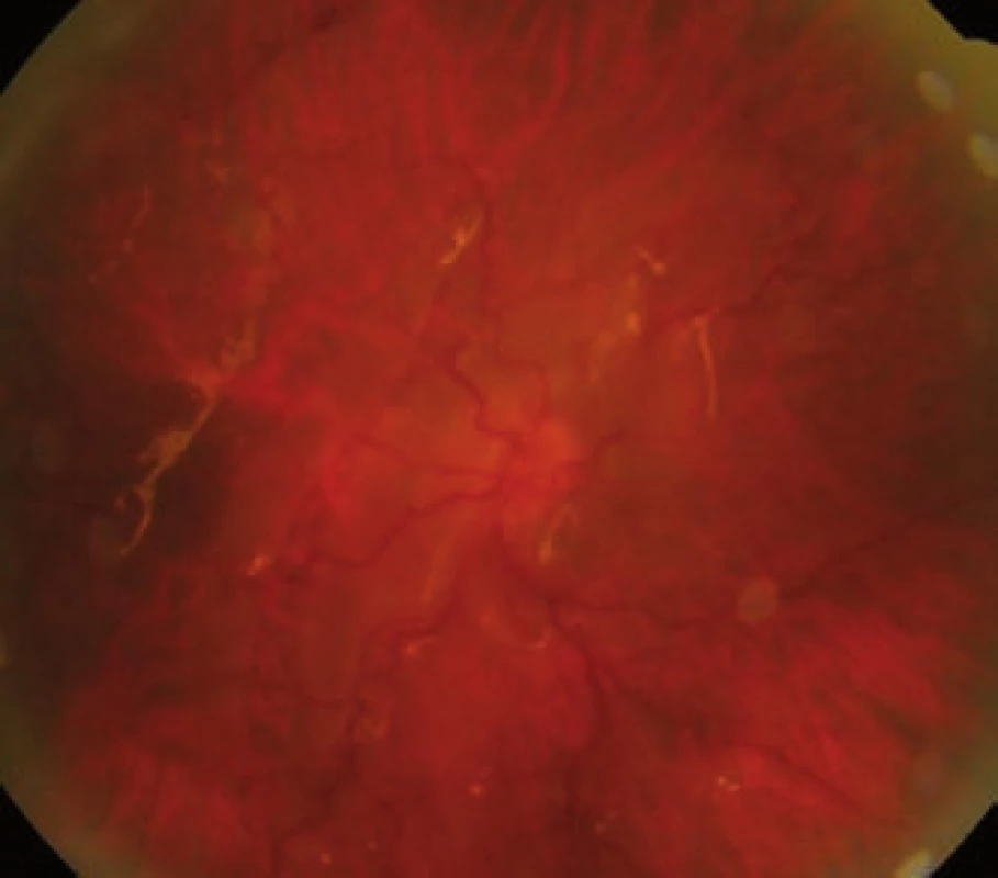 Pooperační nález po 1 měsíci od operace, retina leží, přetrvává její nařasení kolem papily, centrální krajina je distopicky uložená pod papilou, BCVA = 0,02