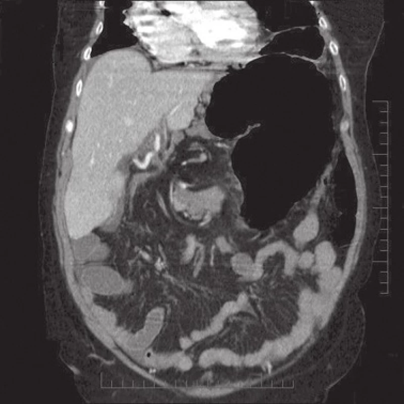 CT vyšetření, frontální řez
Fig. 2: Frontal CT scan