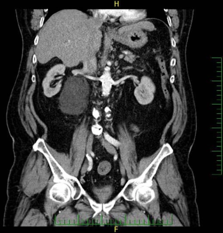 CT, koronární řez, arteriální fáze: neostře ohraničené ložisko lokalizované mediálně od pravé ledviny
Fig. 1. CT scan, coronal section, arterial phase: a lesion lacking well-circumscribed margins located medially to the right kidney