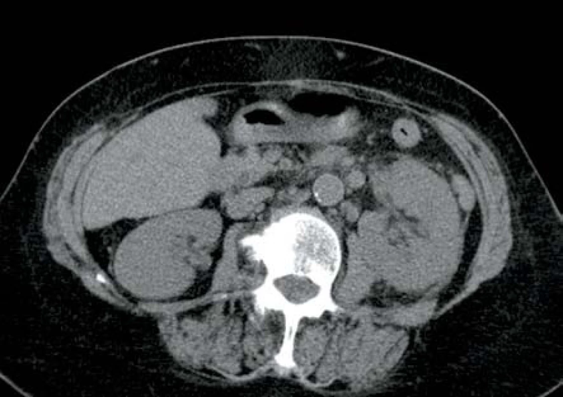 Mírný edém parenchymu levé ledviny s mírnými perirenálními změnami
Fig. 7. Slight oedema of left kidney parenchyma with slight changes in adjacent perirenal tissue