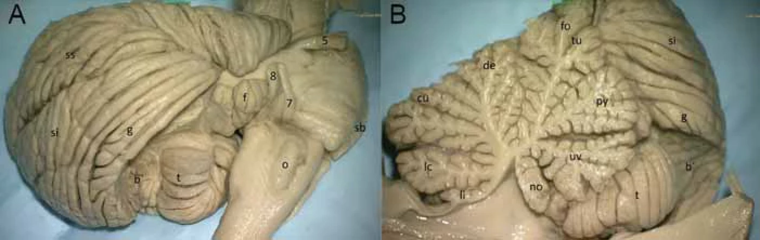 Pohled na tonsillu cerebelli z laterální (A) a mediální (B) strany; z laterální strany byla překryta lobulus biventer, z mediální strany zůstává kraniálně částečně překryta nodulem, uvulou a pyramis vermis.