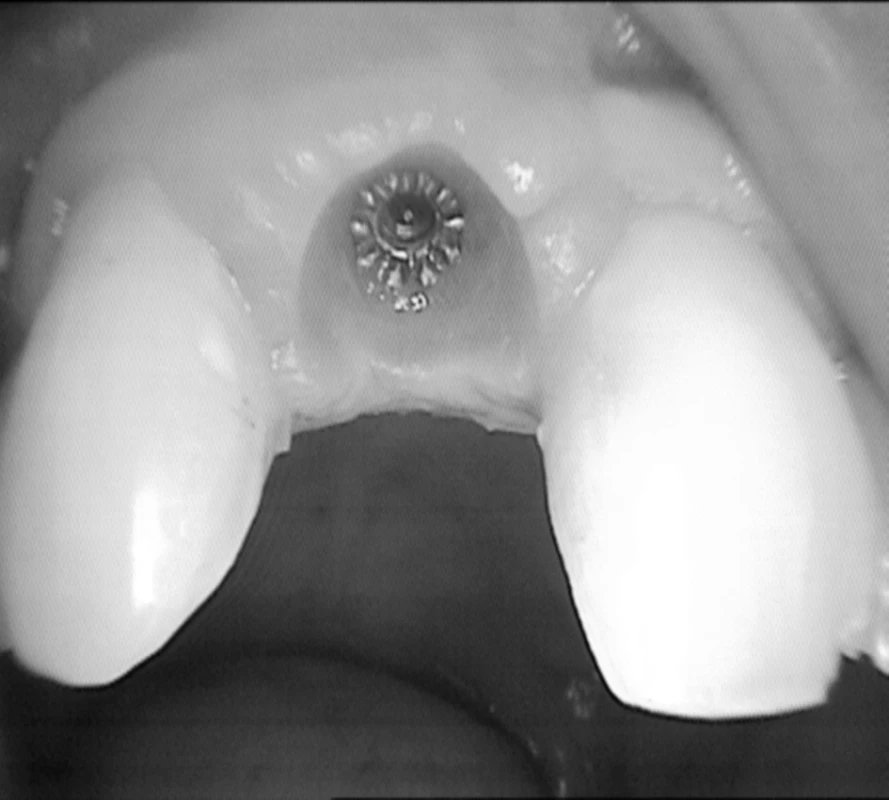 Po 10–14 dňoch je pomocou vhojovacienho valčeka vymodelovaná marginálna gingíva a papily. (Foto: Eurodent medima, s.r.o.)