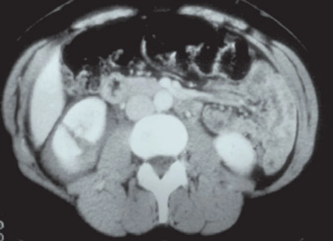 Poranění ledviny IV. grade (stupně).