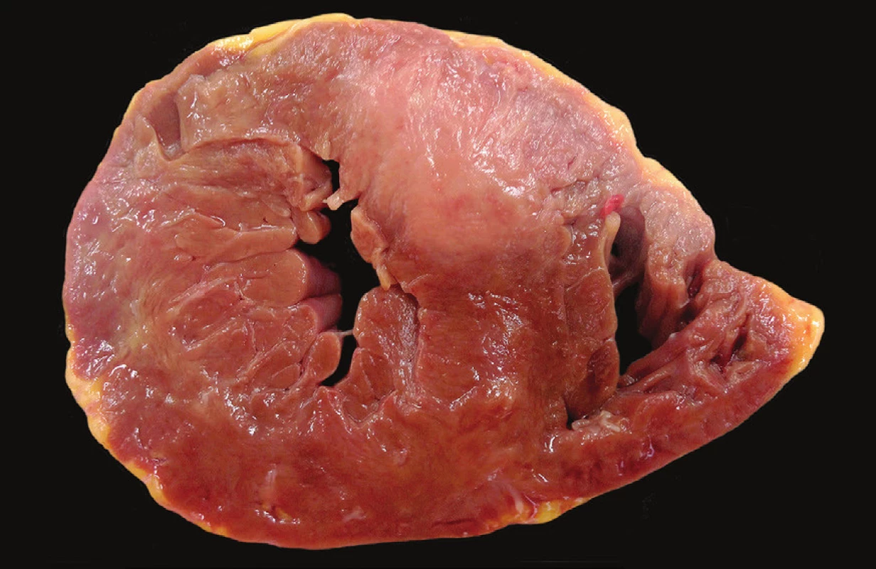 Bělavý tumor v anteroseptální stěně levé srdeční komory.