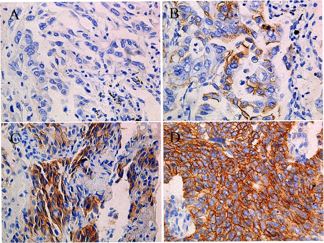 HER-2 protein expression in EGFR wild type lung adenocarcinoma patients by immunohistochemistry: A.0 B.1+ C.2+ D.3+