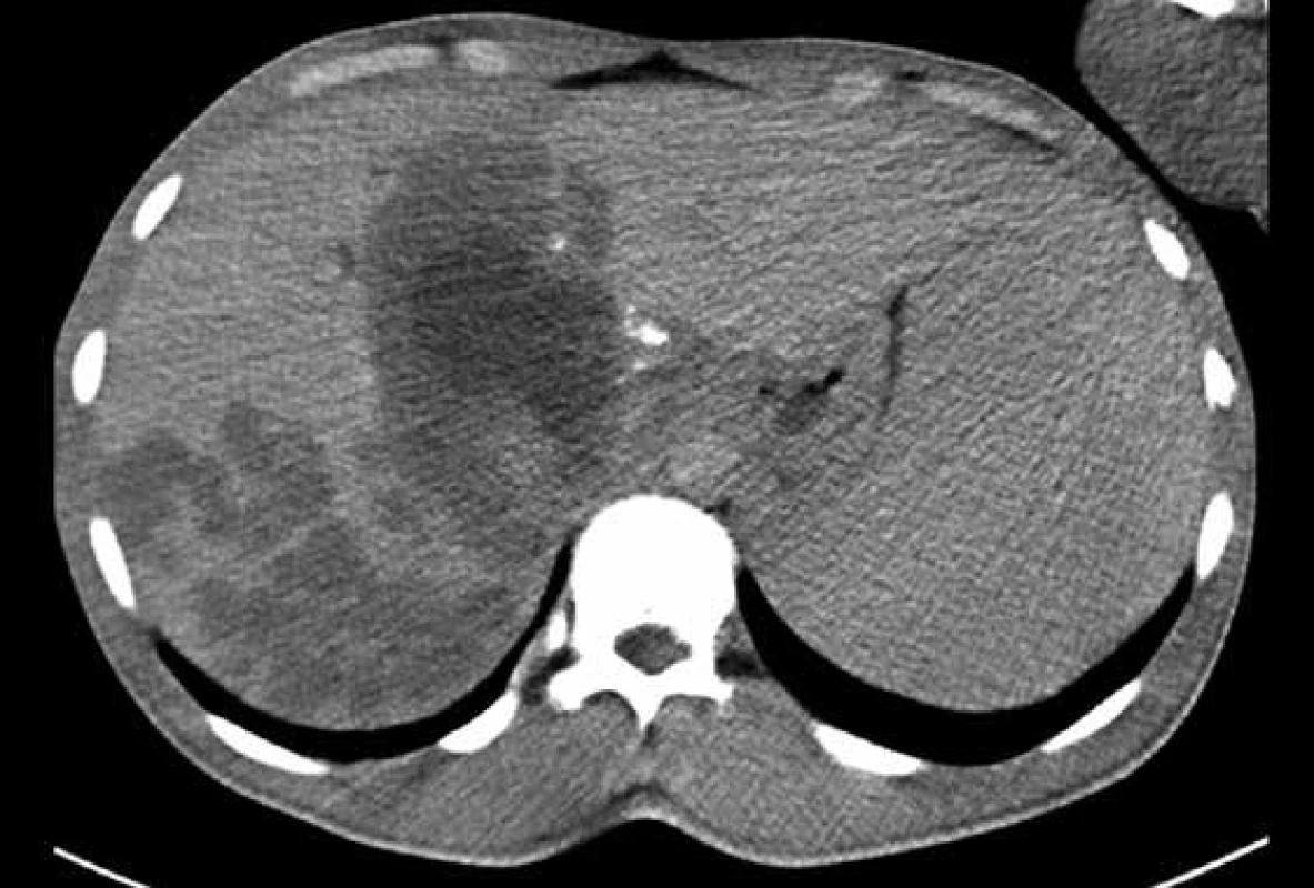CT břicha s nálezem multifokálního postižení jater s centrální nekrózou a kalcifikacemi v okolí. Vytvořeno a laskavě zapůjčeno Radiodiagnostickým ústavem FN Ostrava