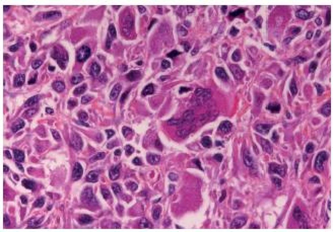 Undifferentiated carcinoma admixed with giant cells.