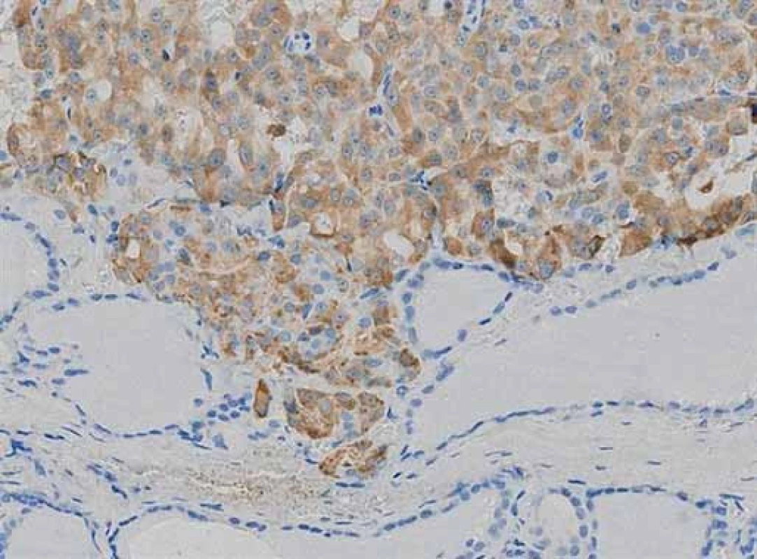 Medulární mikrokarcinom – imunohistologické vyšetření s protilátkou proti kalcitoninu.