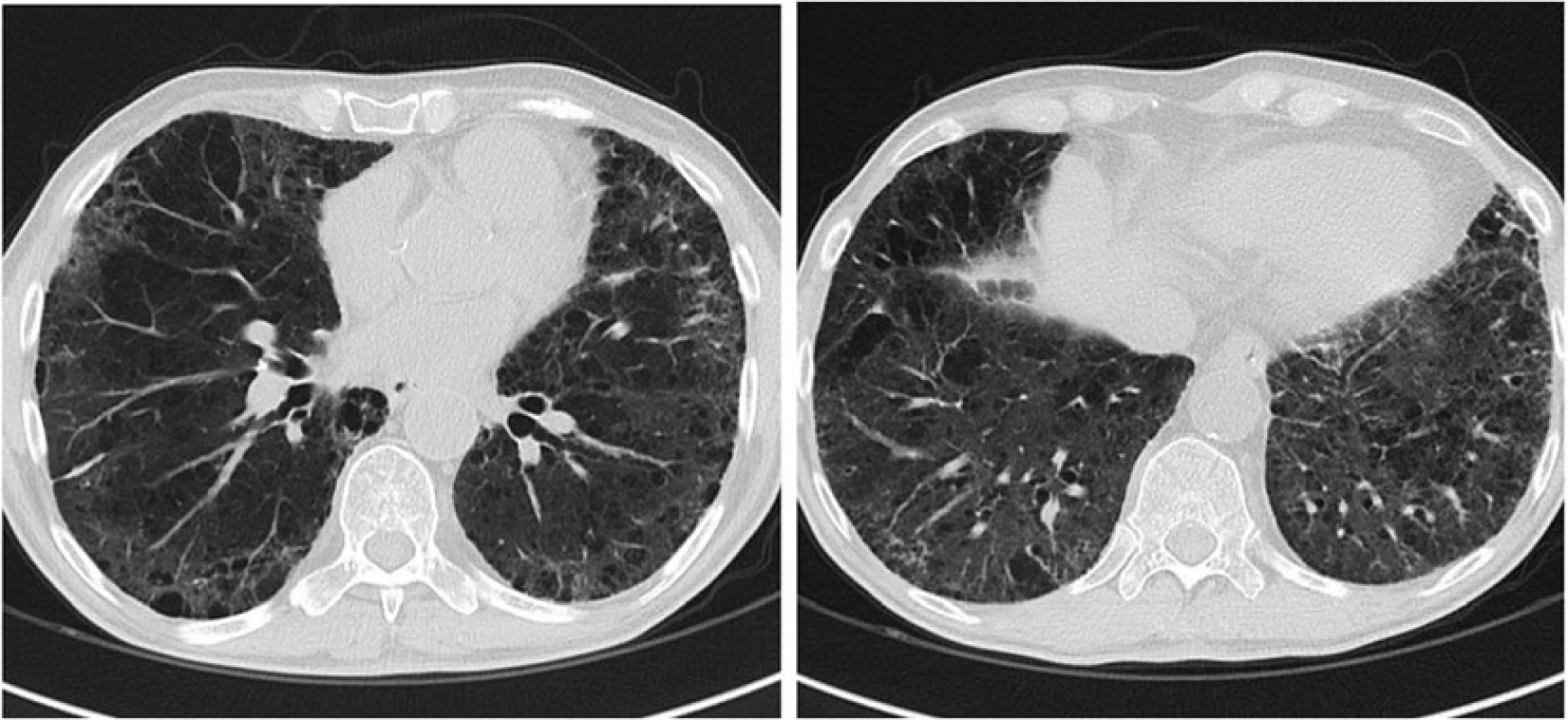 Chest CT scan image obtained 1 month after the start of imatinib mesylate demonstrates resolution of ground-glass opacities and parenchymal consolidation