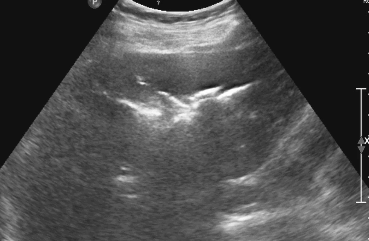 Ultrazvukové vyšetření jater zobrazuje výrazně hyperechogenní obsah ve žlučovodech – což je způsobeno aerobilií
Fig. 3. Ultrasound examination of the liver shows highly hyperechogenic contents of the bile ducts, caused by aerobilia
