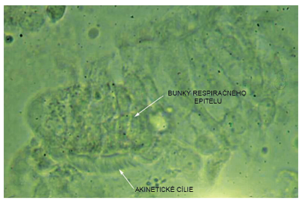 Akinetické cílie zachytené vysokorýchlostnou videomikroskopiou.
Fig. 3. High speed video microscopy image – akinetic cilia.