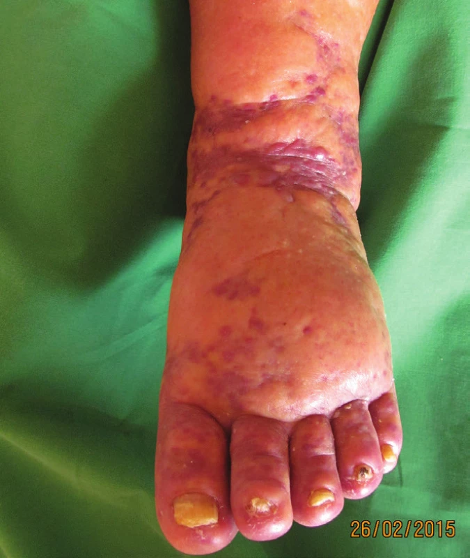Klinický nález plakovité formy KS na levém bérci a dorzu nohy