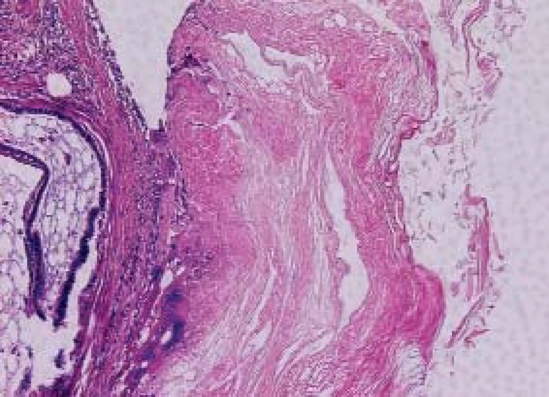 Struktury teratomu, které v pravé polovině mají charakter „epidermoidní“ cysty, vlevo je zachycena tuková tkáň a sliznice připomínající respirační trakt. HE 200x.