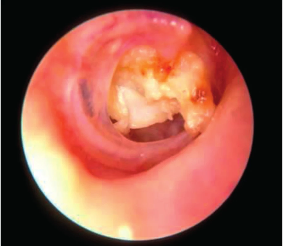 Cholesteatom destruující bubínek a středoušní kůstky, patrné hmoty keratinu.
Fig. 8. Cholesteatoma who destroy the tympanic membrane and middle ear ossicles.
