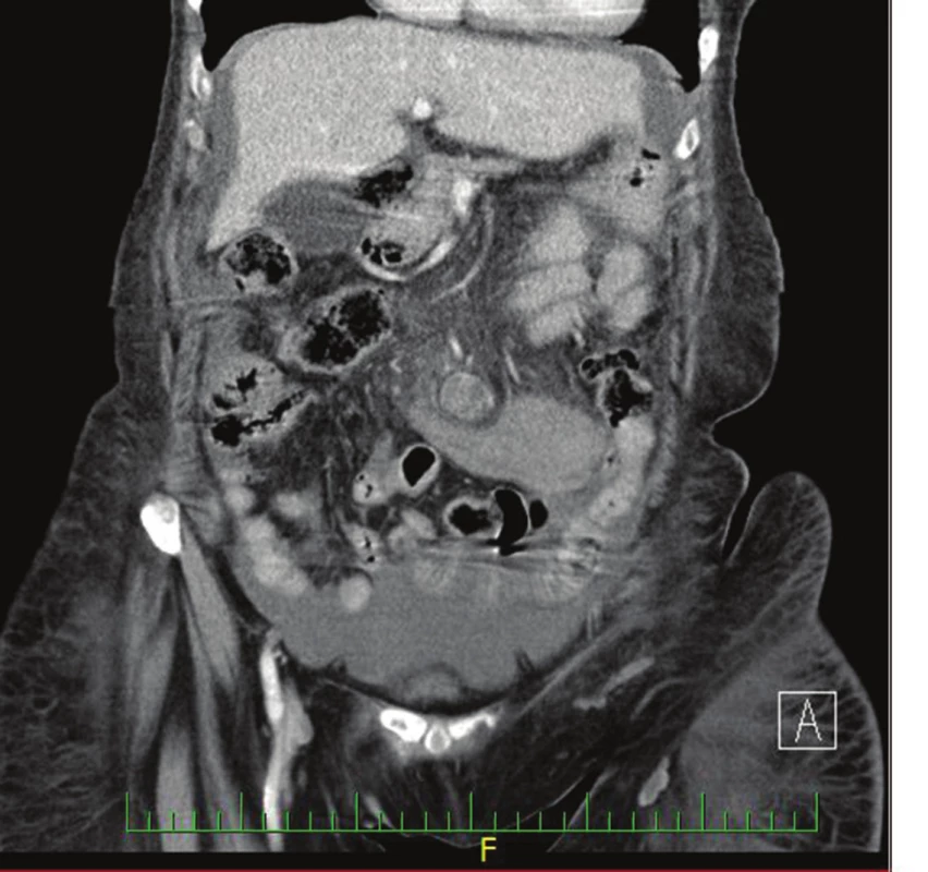 CT nález potvrzující krvácení v blízkosti horní mezenterické tepny
Fig. 2: CT finding confirming bleeding near the superior mesenteric artery