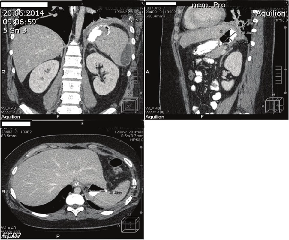 CT obrázek akutní kolekce v levém subfreniu při leaku po LGCP
Fig. 3: CT scan of acute left subphrenic collection due to a leak after LGCP