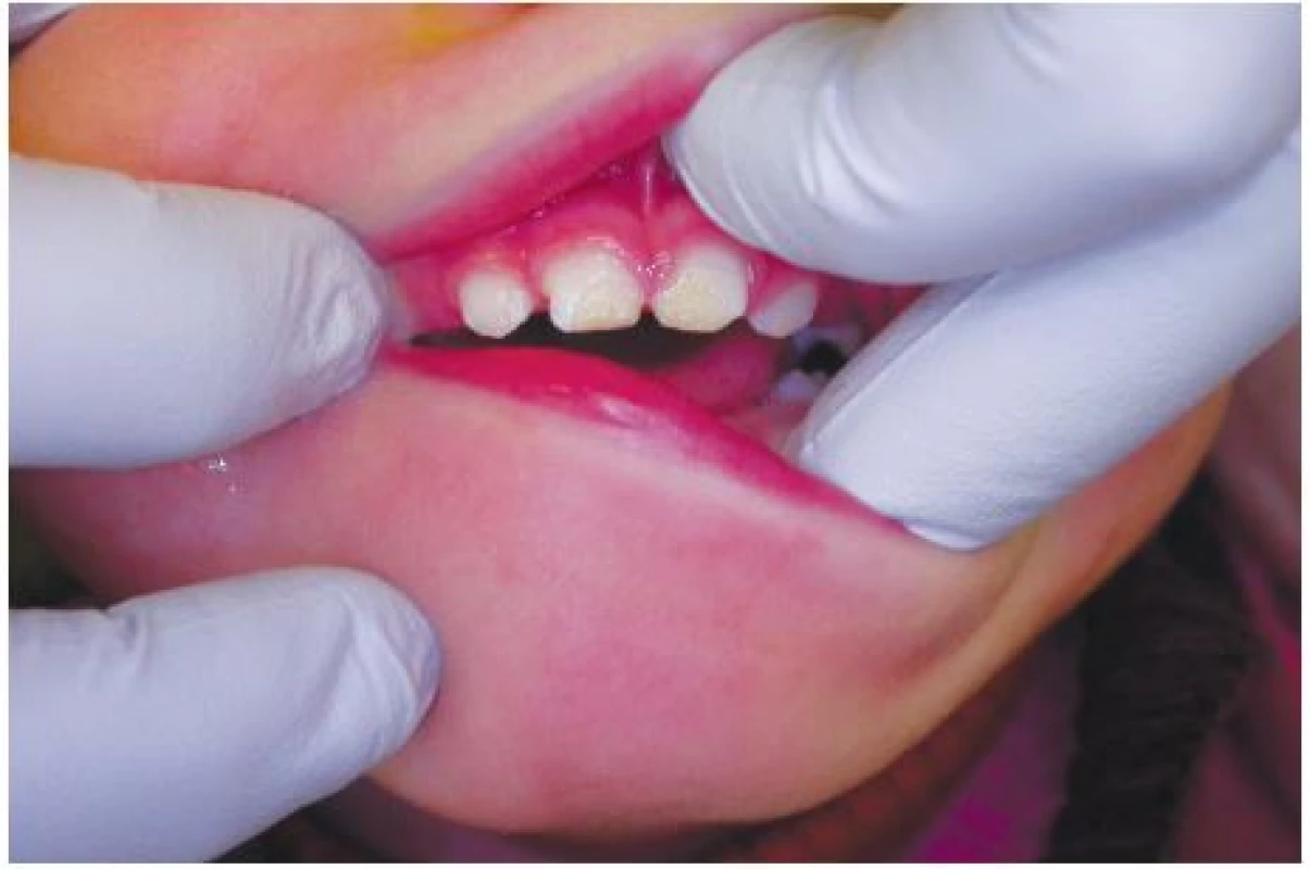  1 Hypoplastické změny skloviny zubů 51 a 61 u dítěte narozeného předčasně s extrémně nízkou porodní hmotností<br>
Fig. 1 Enamel hypoplasia in
the child with extremely low
birth-weight (teeth 51 and 61)