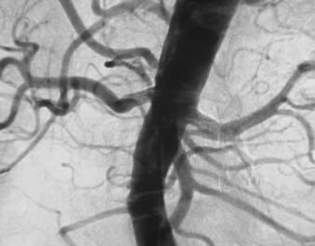 Kontrolní angiografie AA po oboustranné PTRA s implantací stentů a s normalizací šíře lumen renálních tepen.