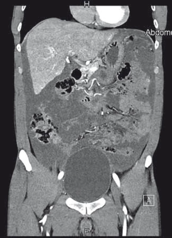 První CT vyšetření s nálezem galatinózních hmot vyplňujících dutinu břišní.
Fig. 1. First abdominal CT scan showing the abdominal cavity filled with mucoid fluid.