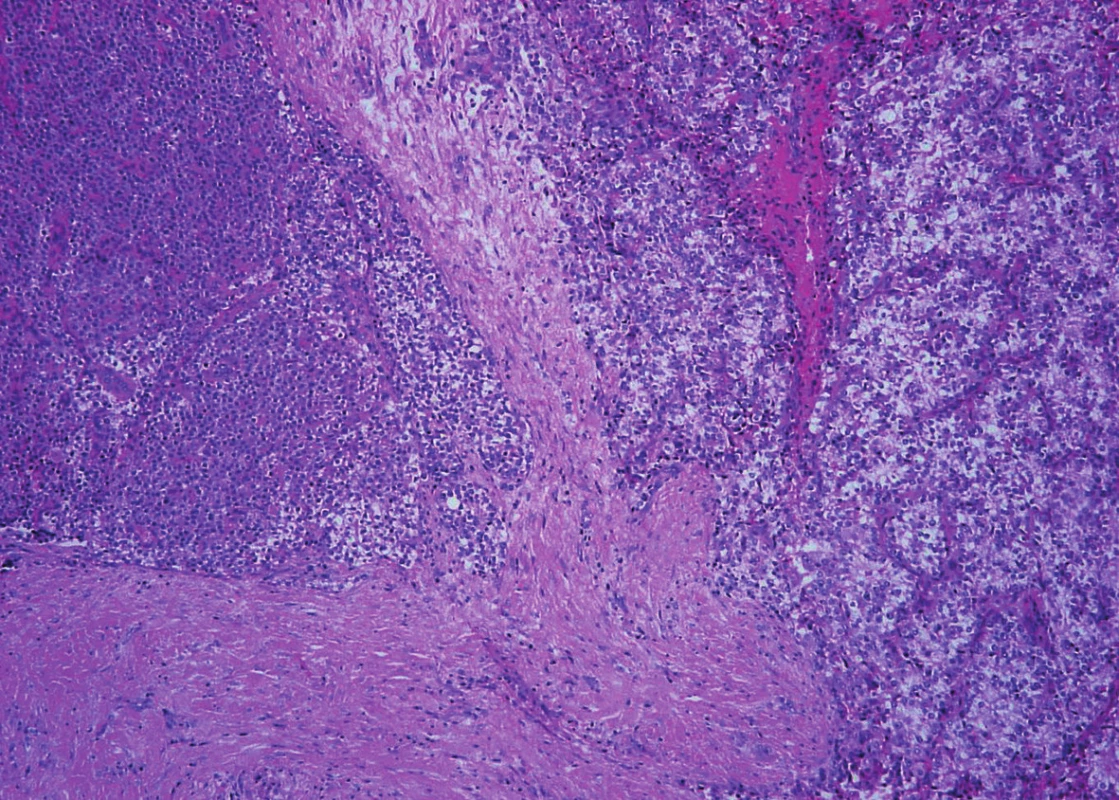 Parathyroid carcinoma. Tumor with infiltrative growth into the surronding soft tissue. Trabeculae of neoplastic cells with intralesional dense fibrous bands (hematoxylin and eosin, magnifications x 100).