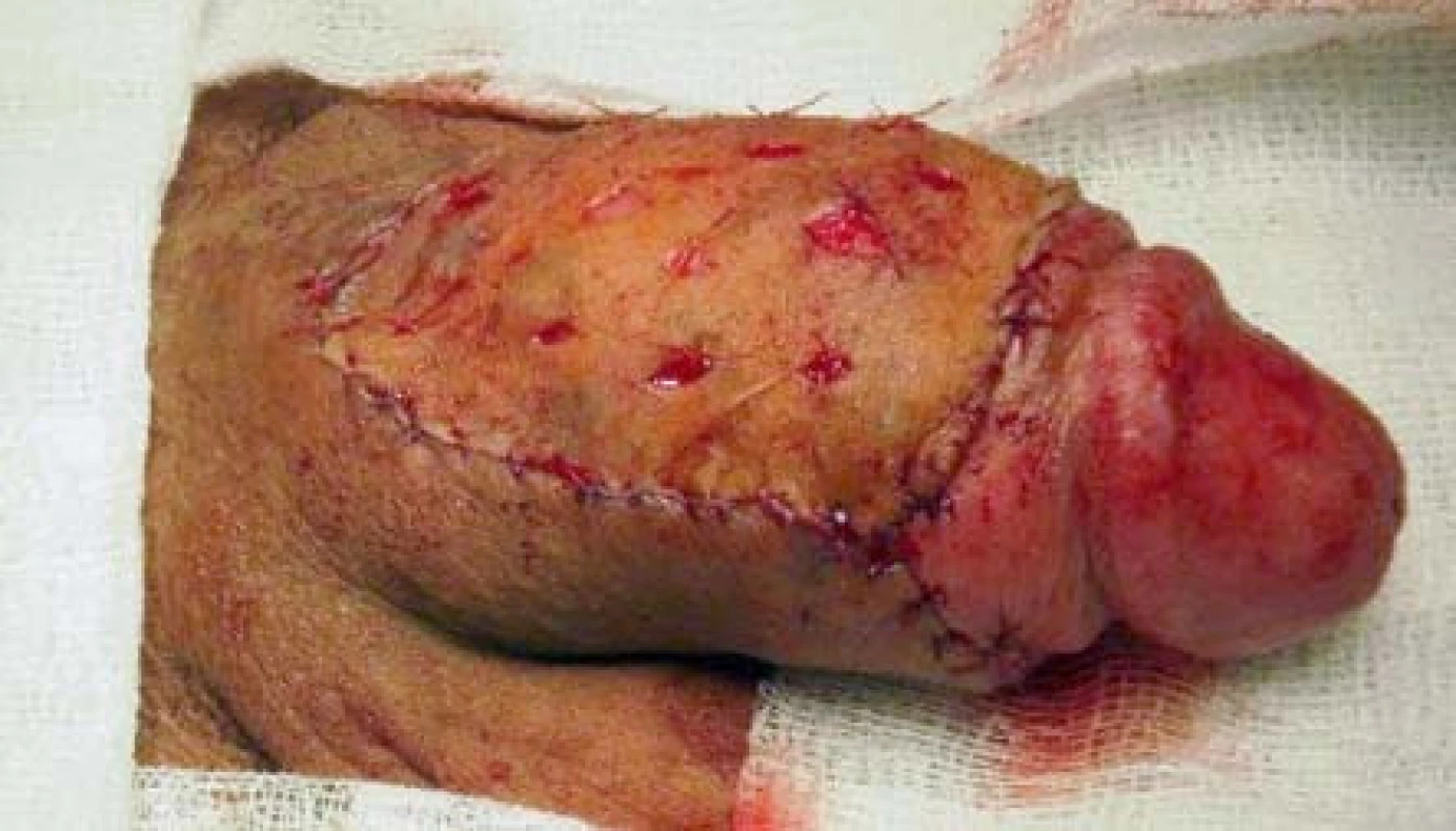 Cirkumcize a plastika dermoepidermálním štěpem
Fig. 3. Circumcision and reconstruction with split-thickness skin graft – STSG