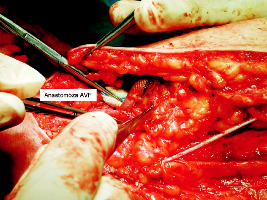 Anastomóza vena basilica s arteria brachialis
Fig. 4. Anastomosis between the vena basilica and arteria brachialis