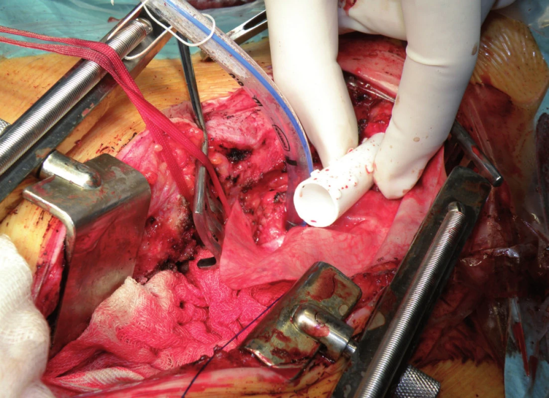 Operační výkon (resekce stenotického úseku trachey s implantací stentu))