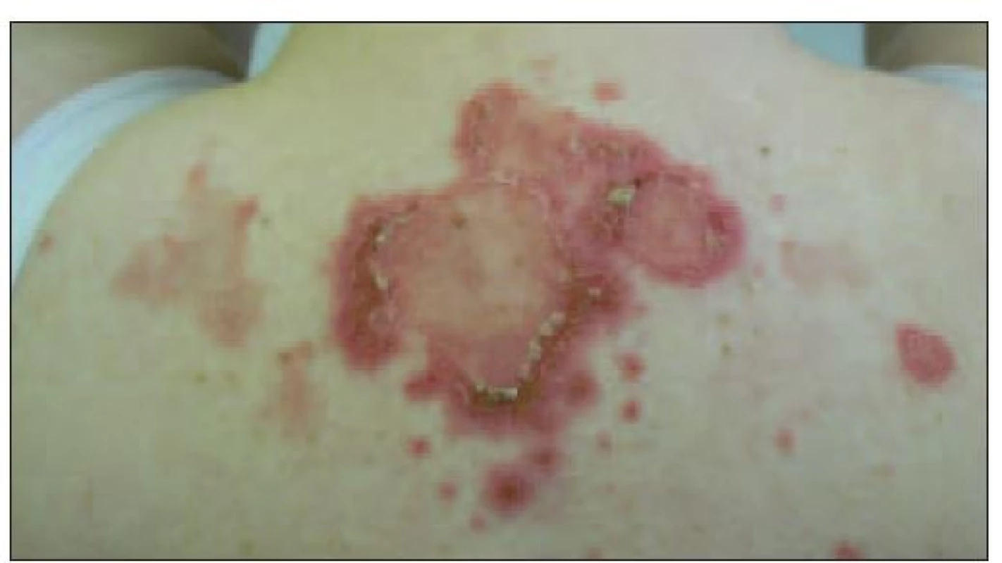 Subakútny kožný lupus erytematózus.