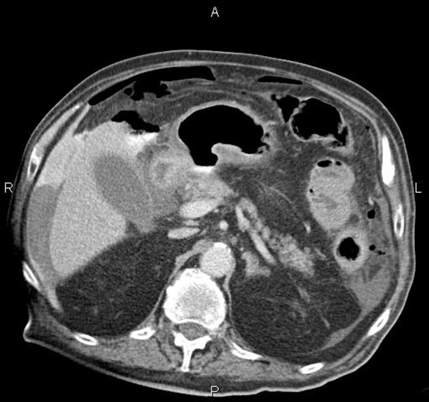 CT vyšetření: pneumoperitoneum pod ventrální stěnou břišní a volná tekutina při laterálním okraji pravého laloku jaterního; zvýšená denzita volné tekutiny svědčí pro hnisavý výpotek nebo hemoperitoneum