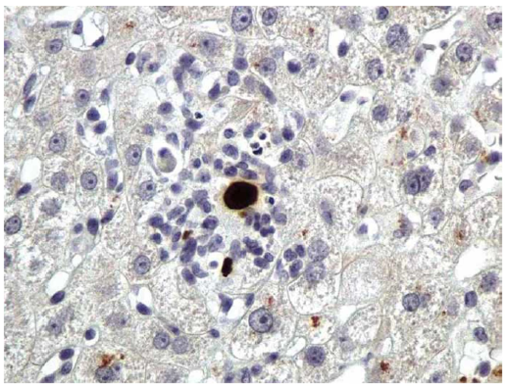 CMV hepatitida. Imunohistochemická detekce okamžitého časného antigenu CMV (buňky infikované CMV jsou hnědé). Primární myší monoklonální anti-CMV protilátka (klon CCH2 + DDG9, Dako), původní zvětšení 400×.
Fig. 2. CMV hepatitis. Immunohistochemical detection of CMV immediate early antigen (CMV/infected cells are brown). Primary mouse monoclonal anti-CMV antibody (clone CCH2 + DDG9, Dako), original magnification ×400.
