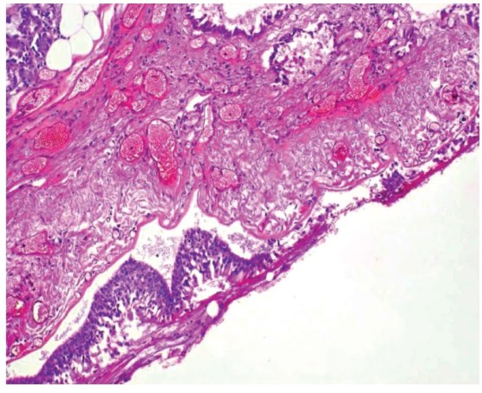 Mikroskopický obraz hemoragické tracheitidy