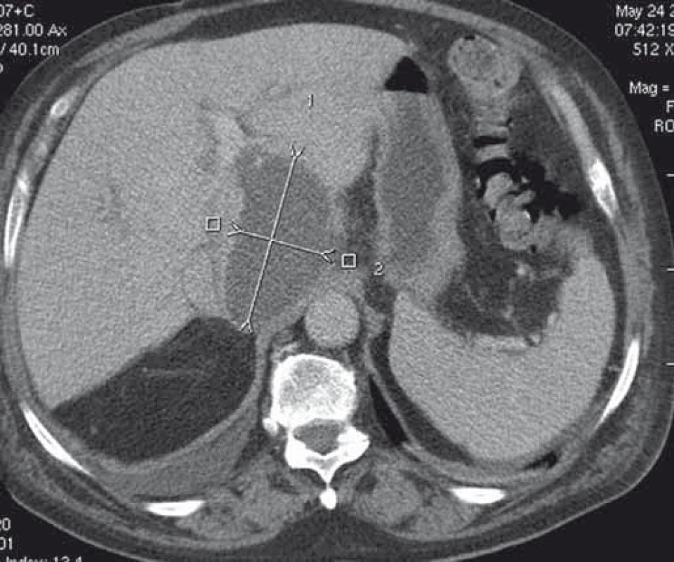 CT obraz abscesu v lobus caudatus pečene.
Fig. 8. CT image of an abscess in the caudate lobe of the liver.