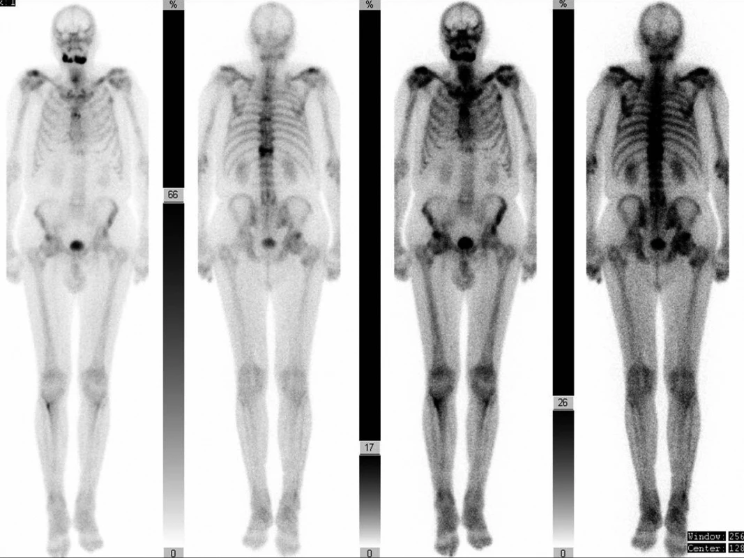 Celotělová scintigrafie skeletu 99mTc-MDP – planární zobrazení pacienta z obr. 1 – patologicky zvýšený kostní metabolický obrat v pravé i levé polovině těla mandibuly, zvýšená akumulace i na úrovni hrudní páteře (Th XI, IX, a V – pravděpodobně kompresivní fraktury), laterálně v 2. žebru vlevo (starší zlomenina nebo souvislost se základním onemocněním) a změny degenerativního původu v oblasti ramenních a kyčelních kloubů. (Zdroj obr.: Klinika zobrazovacích metod LF UK a FN Plzeň)