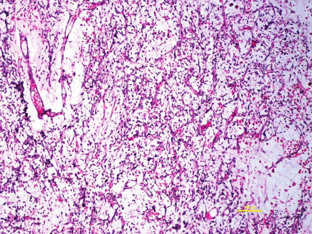 Klasickým zástupcem maligních myxoidních nádorů měkkých tkání je myxoidní liposarkom, obvykle snadno rozpoznatelný pro svoji charakteristickou plexiformní kapilární síť.