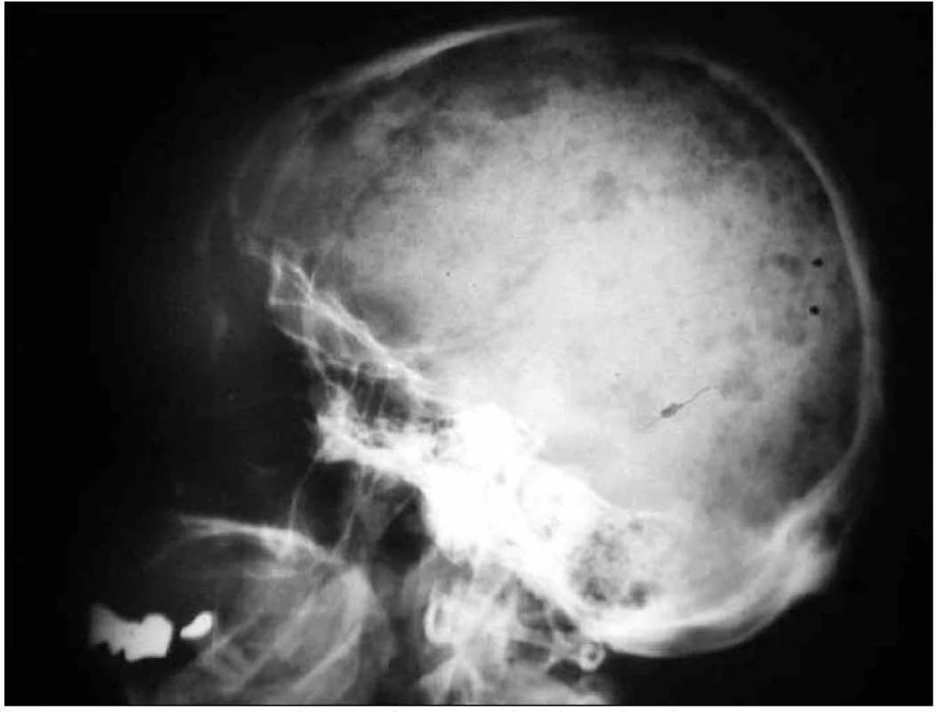 Boční RTG snímek s typickým osteolytickými ložisky u pacienta s mnohočetným myelomem.