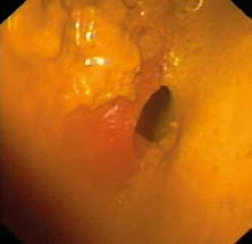 Gastroskopia: colon transversum vyplnené stolicou.
Fig. 2. Upper endoscopy: transverse colon filled with stool.