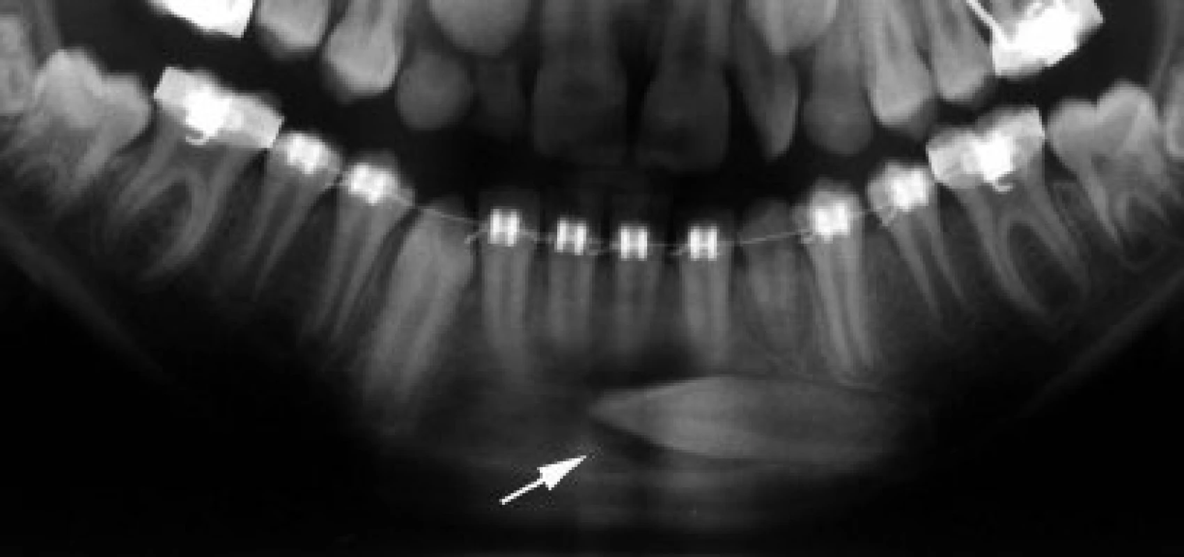 Detail z ortopantomogramu (OPG) pacientky ve věku 11 let a 3 měsíce. Levý dolní stálý špičák (bílá šipka) prořezává ektopicky a má horizontální polohu, která je nevýhodná pro ortodontické zařazování.