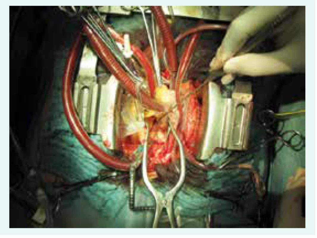 Operační pole v průběhu plicní endarterektomie.
Nástroj směřuje do otevřené obturované
pravé větve plicnice