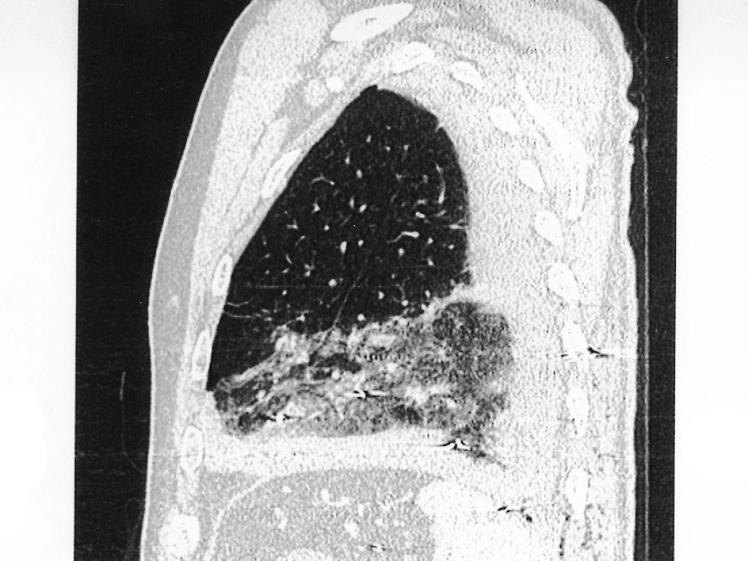 CT-scan – vícečetné zástřely broky do hrudní stěny, dolního laloku levé plíce (rozsáhlé prokrvácení), bránice, žaludku a sleziny
Pic. 2. CT-scan – multiple cold shots within the thoracic wall, left inferior lung lobe (massive bleeding), diaphragm, stomach and spleen