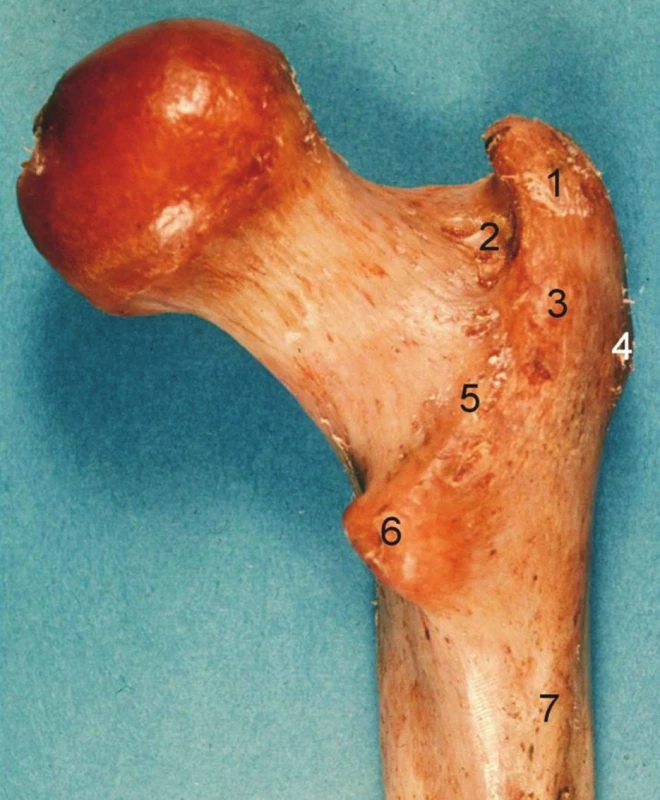 Proximální femur, pravá strana, pohled zezadu: 1 – fossa piriformis, 2 – fossa trochanterica, 3 – trochanter major, 4 – tuberculum vastoabductorium, 5 – crista intertrochanterica, 6 – trochanter minor, 7 – tuberositas glutea.
Fig. 2: Proximal femur, right side, posterior aspect: 1 – fossa piriformis, 2 – fossa trochanterica, 3 – trochanter major, 4 – tuberculum vastoabductorium, 5 – crista intertrochanterica, 6 – trochanter minor, 7 – tuberositas glutea.