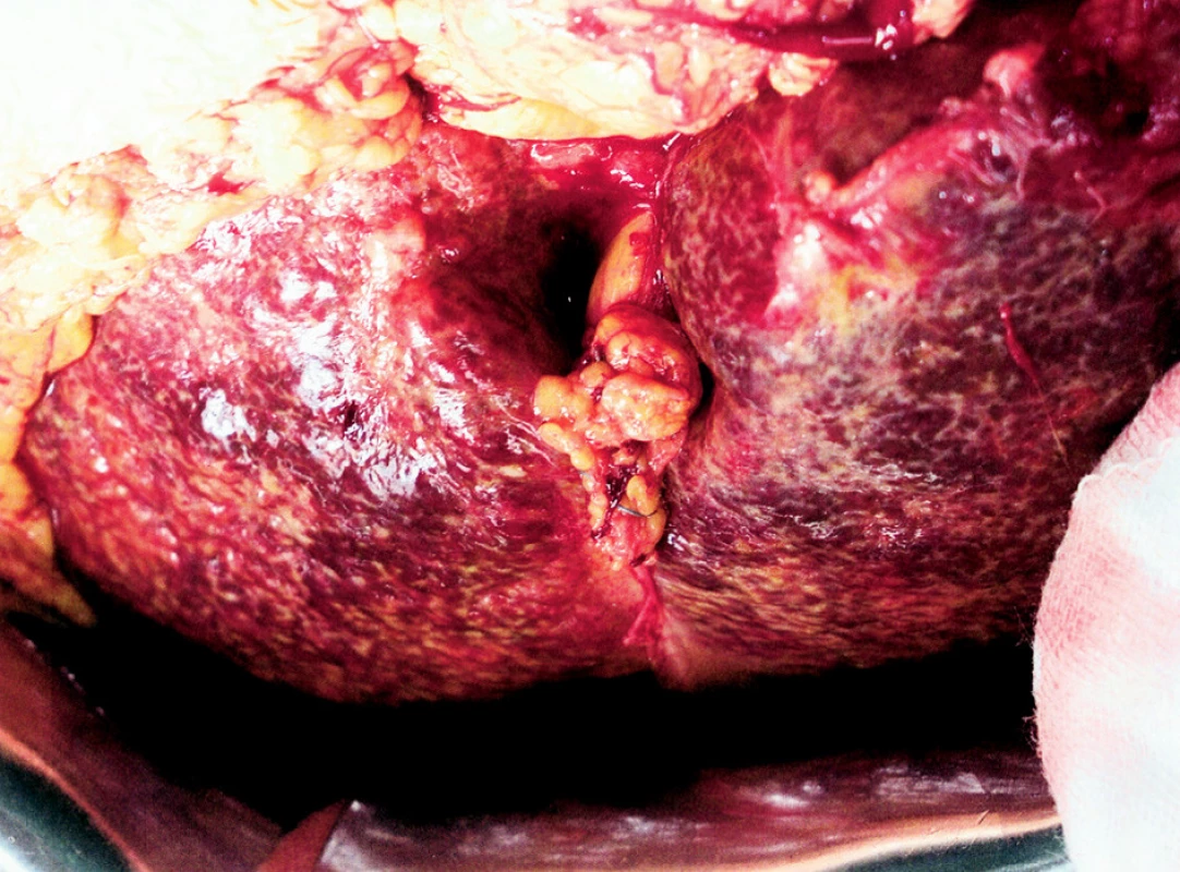 Těžká cirhóza jater s hepatolitiázou v levém laloku
Fig. 1. Severe liver cirrhosis with hepatolithiasis in the left liver lobe