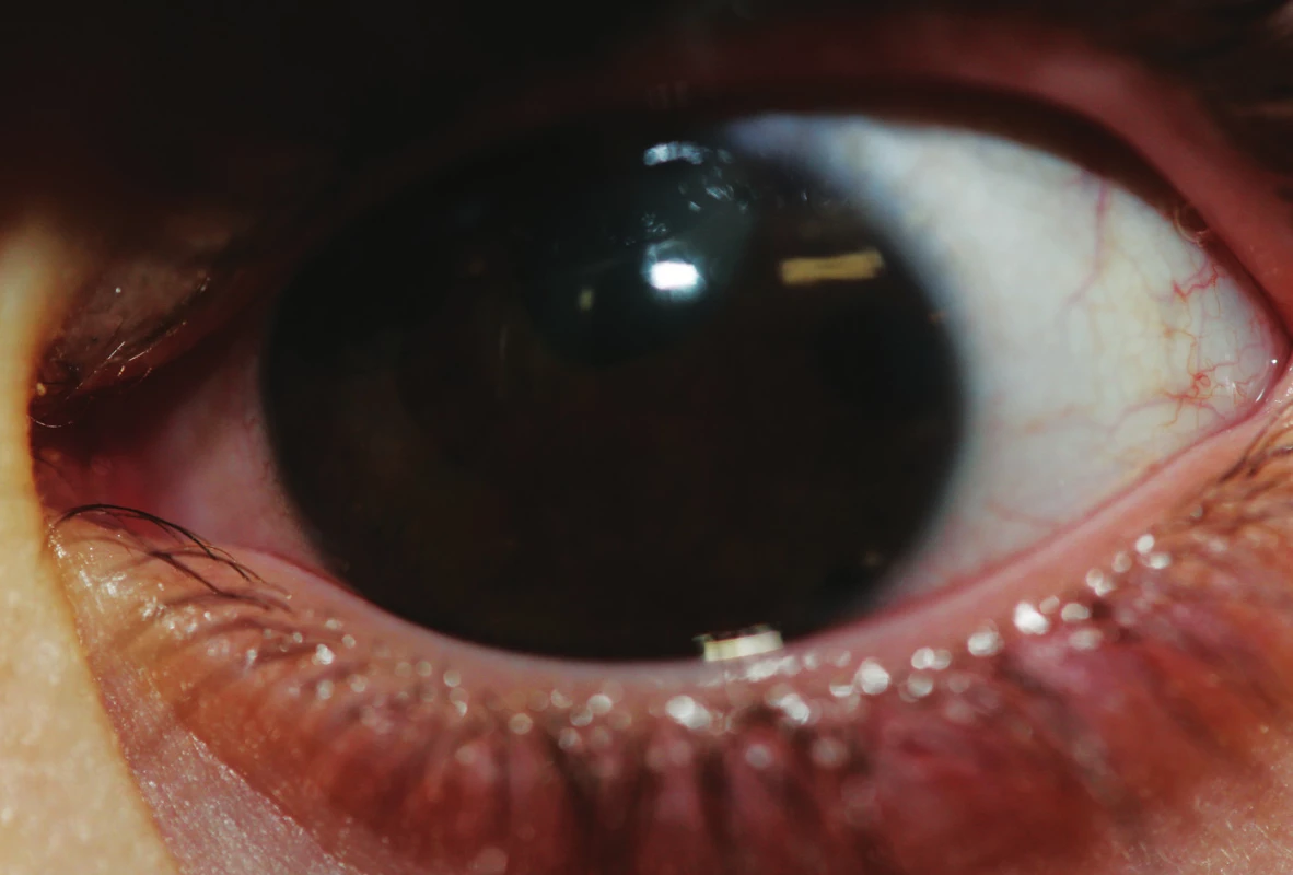 Obraz ľavého oka s totálnou iridektomiou při č. 1 po operácii