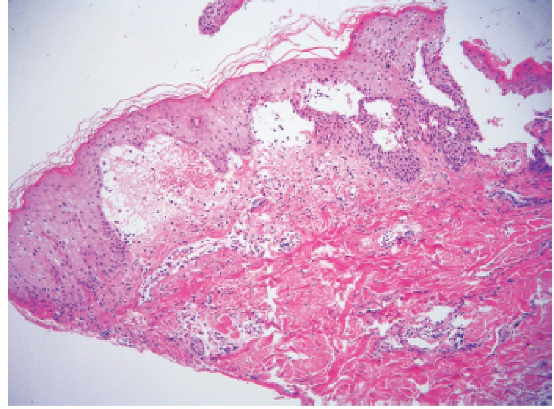 Subepidermální edém přecházející v buly s obsahem lymfocytů a eozinofilů – obraz blízký dermálnímu typu erythema multiforme