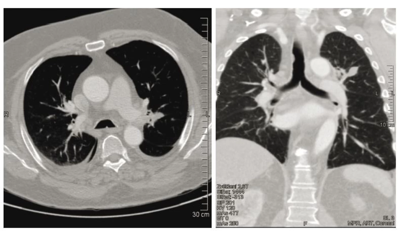 Kontrolní CT nález
s morfologickou regresí infiltrace
plicního parenchymu