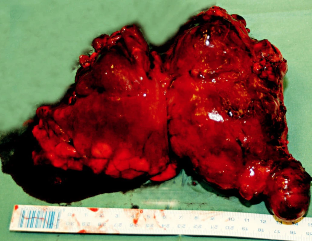 Vlastní resekát tumoru
Fig. 4. The resected tumor