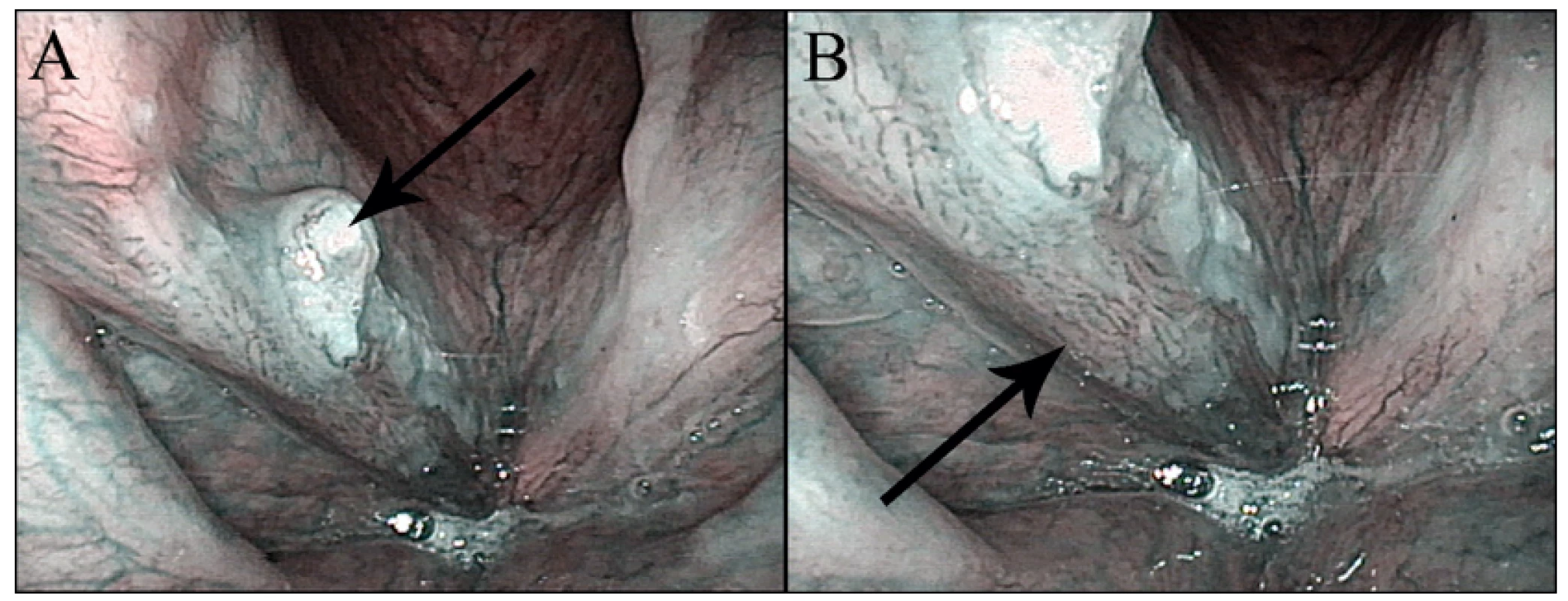 Obr. 2  Konvenční (nezvětšovací) NBI endoskopie – spinocelulární karcinom hlasivky: A – přehledný snímek s exofytickou částí tumoru (šipka), B – detail s patrnou patologickou vaskularizací v okrajích tumoru (šipka).