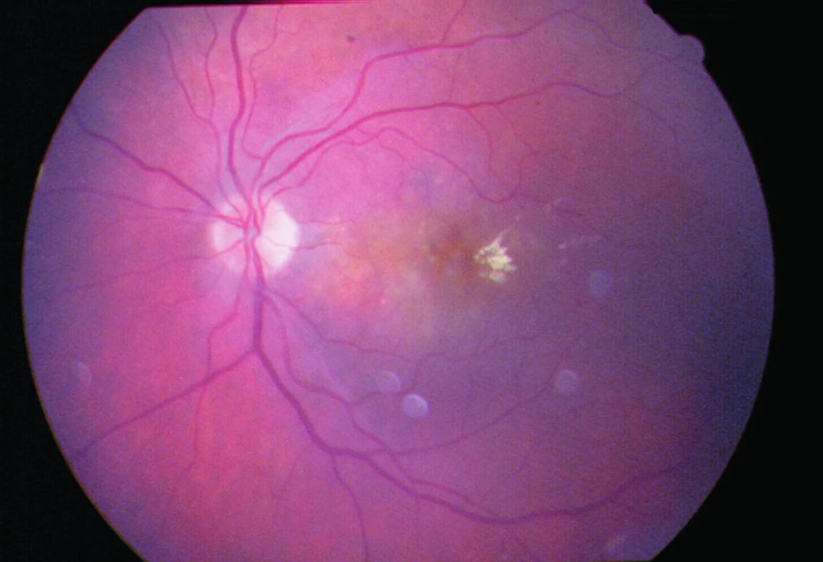 Farebný snímok ľavého oka klasickej SRNM