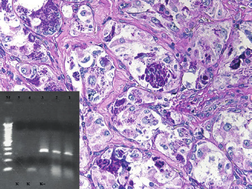 Kazuistika 10. Alveolární sarkom měkkých tkání, nádor s typickým uspořádáním, velkými polygonálními nádorovými buňkami a s charakteristickými intracytoplazmatickými krystalickými strukturami. Barveno metodou PAS (původní zvětšení 400x). Vložený obrázek: Agarózový gel s detekcí fúzního genu ASPL/TFE3, který je produktem translokace t(X;17). Zprava: 1. metastáza z roku 2013, 2. primární nádor, 3. pozitivní kontrola RT-PCR, 4. negativní kontrola RT, 5. negativní kontrola PCR, M - 100 bp velikostní marker.