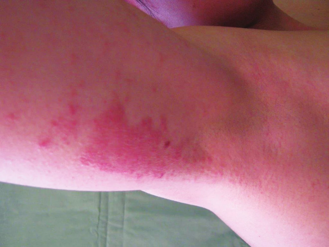 Alergická kontaktní dermatitida na isothiazolinony v deodorantu