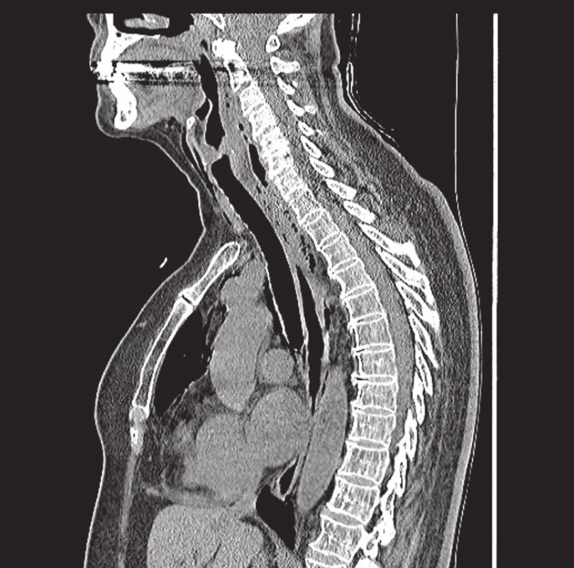 CT hrudníku a krku v sagitální rovině: v zadním mediastinu prevertebrálně a v retrofaryngeálním prostoru, v úrovni C2 až Th5 jsou patrné mnohočetné bubliny vzduchu, drobnější a méně četné bubliny vzduchu jsou i paraesofageálně, pretracheálně, podél aortálního oblouku a dostupujících velkých cév a v podkoží krku.